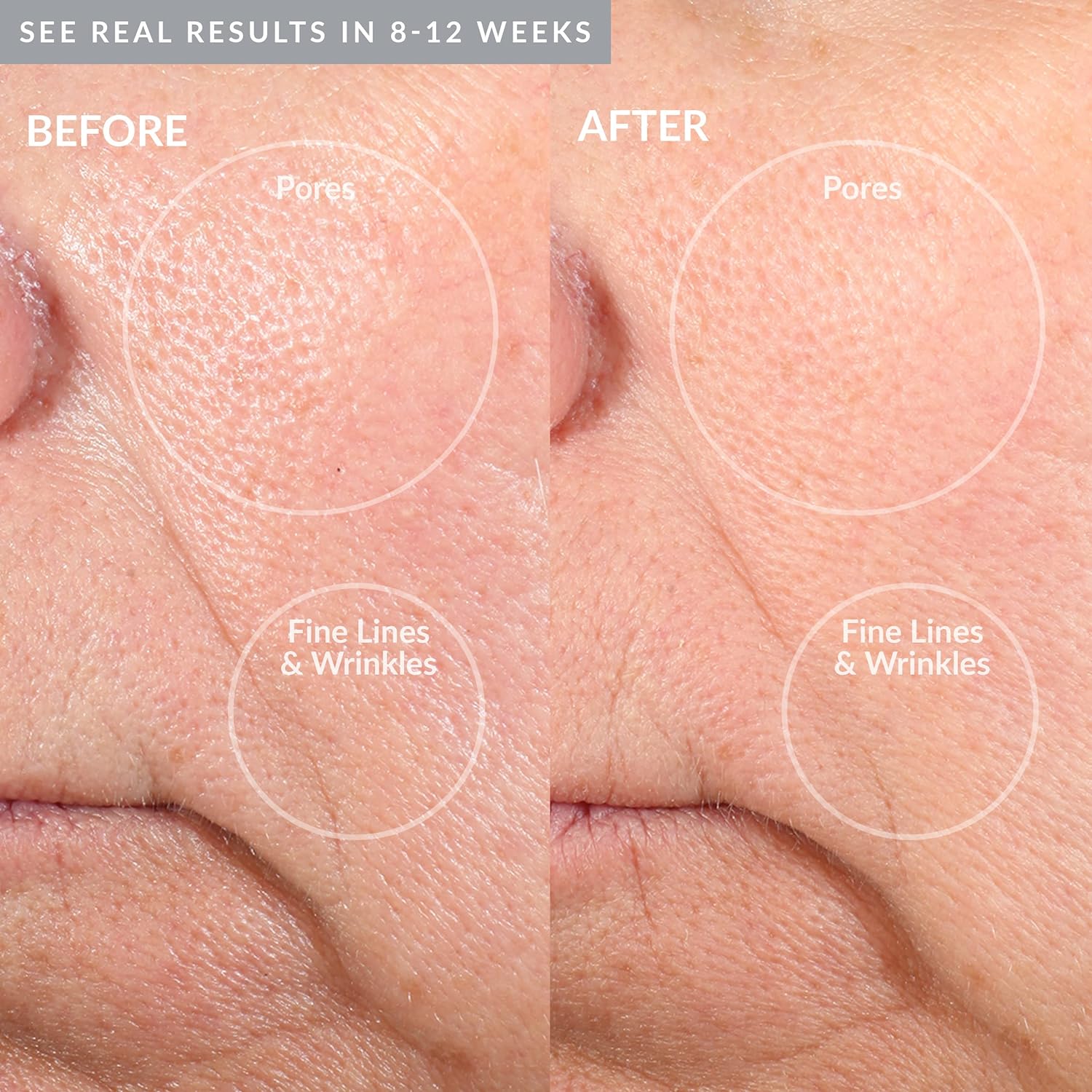 Personal Microderm Elite Pro (PMD)
